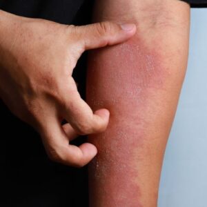 eczema karite
