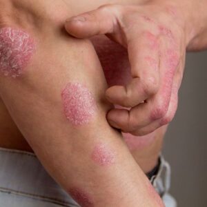 psoriasis karité