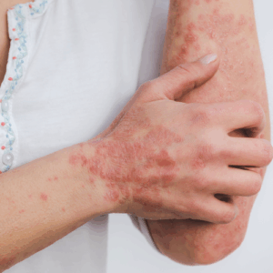 psoriasis alimentation bio naturel