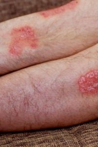 psoriasis en plaque rougeurs