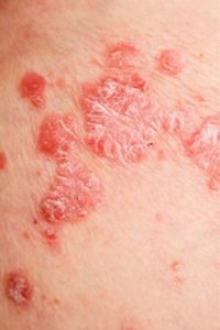 rougeurs du psoriasis en goutte