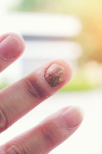 psoriasis unguéal ou psoriasis de l'ongle