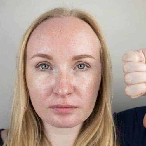 acné peau grasse