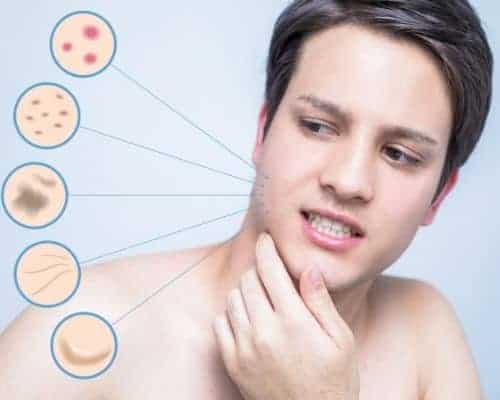 Manifestations de l'acné