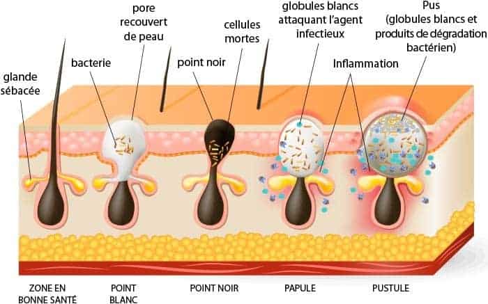 acné causes