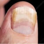 psoriasis de l'ongle