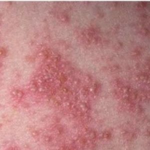 psoriasis érythrodermique