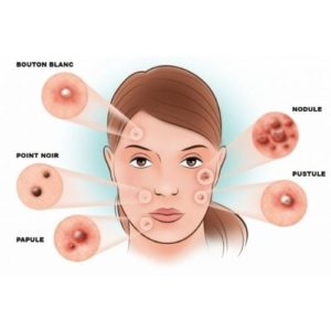 schéma sur l'acné et les boutons