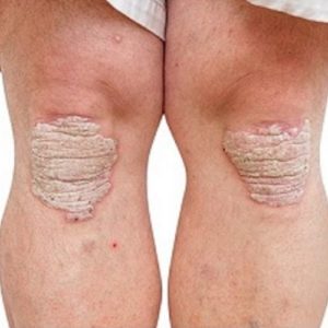 psoriasis en plaque sur les genoux