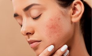 traitements naturels pour acné kystique