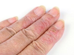 Eczéma de contact sur les mains