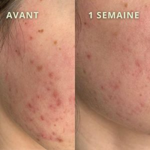 avant apres acne akno complexe