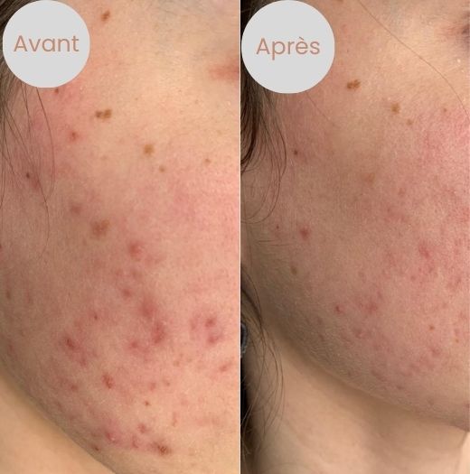avant et après utilisation complexe acno