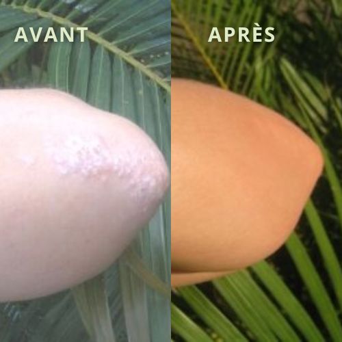 eczema coude photo avant après