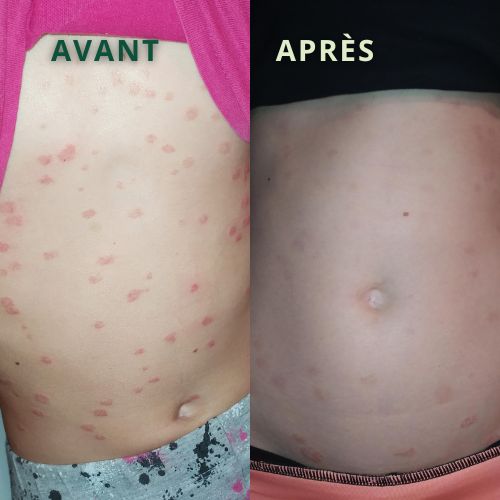 ventre psoriasis avant après