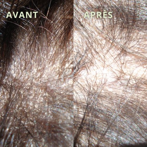 psoriasis cuir chevelu avant après photos