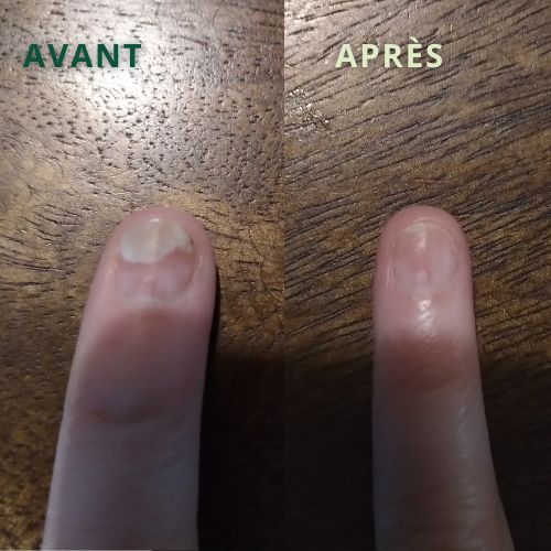 psoriasis ongle avant après temoignage