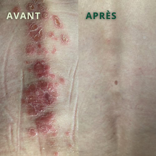 Photos avant après psoriasis dos