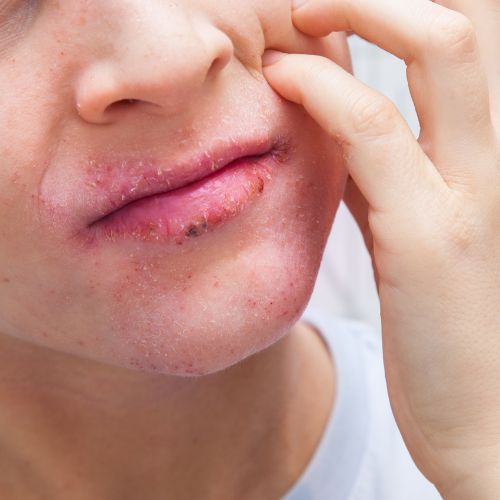 Eczéma du visage quelles causes et quels traitements