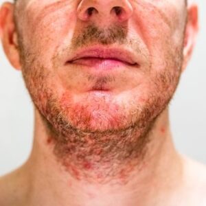 psoriasis léger à modéré sur visage et barbe