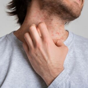 symptomes de l'eczema nerveux