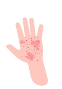 Eczéma pustulent
