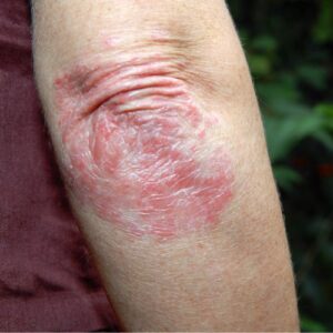 psoriasis sans ordonnance, plaque rouge coude 