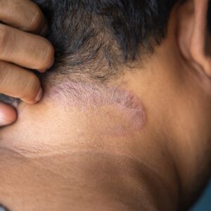 psoriasis-sans-ordonnance-cou