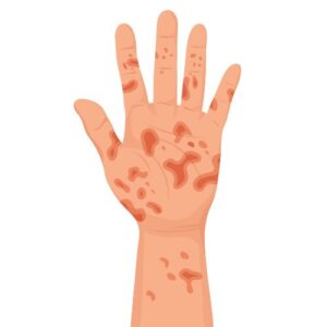 eczema allergique main