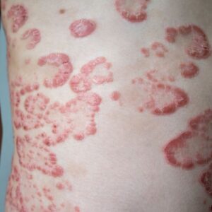 psoriasis contagieux explication