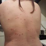 psoriasis en goutte sur le dos 