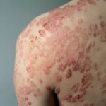 psoriasis contagieux en plaque 