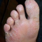 psoriasis contagieux palmo plantaire 