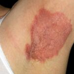 psoriasis des plis ou inversé 