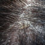 plaques et croutes du au psoriasis du cuir chevelu 