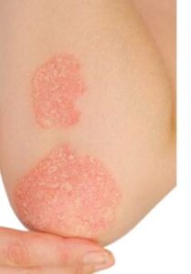 Psoriasis anomalies de la peau
