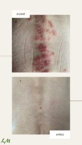 Psoriasis dans le dos, photos avant-après traitement psoriasis Pso Natura.