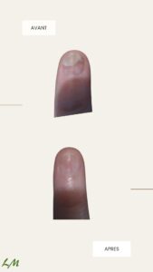 Photos avant-après psoriasis unguéal, psoriasis des ongles