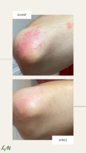Psoriasis photos avant-après grâce aux soins naturels Pso Natura