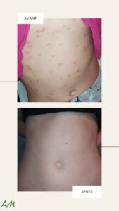Photos psoriasis en gouttes sur le ventre