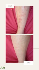 psoriasis sur les jambes, photo avant-après 