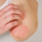 psoriasis sur le coude en photo