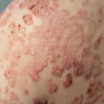 psoriasis en gouttes en photo