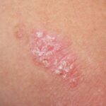 Psoriasis en plaque sur le coude