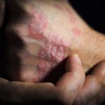 psoriasis des mains et pieds en photo