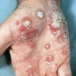 psoriasis pustuleux en photo