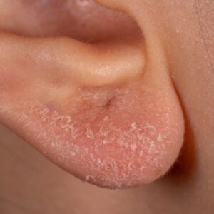 eczéma de l'oreille, comment le reconnaître et comment le différencier du psoriasis ?