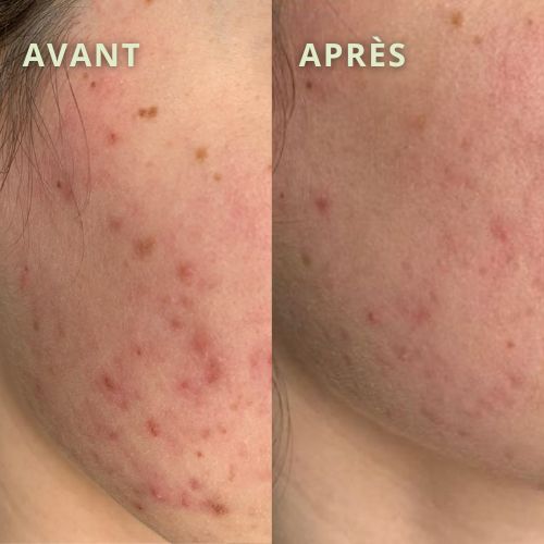 temoignage acne joues