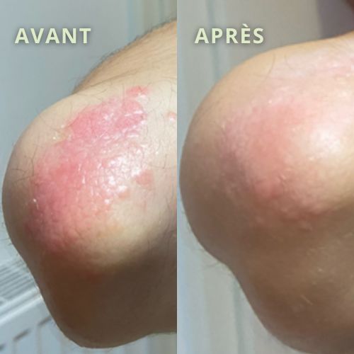 coude-avant-après-psoriasis