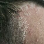 cuir chevelu qui gratte à cause d'un psoriasis des cheveux